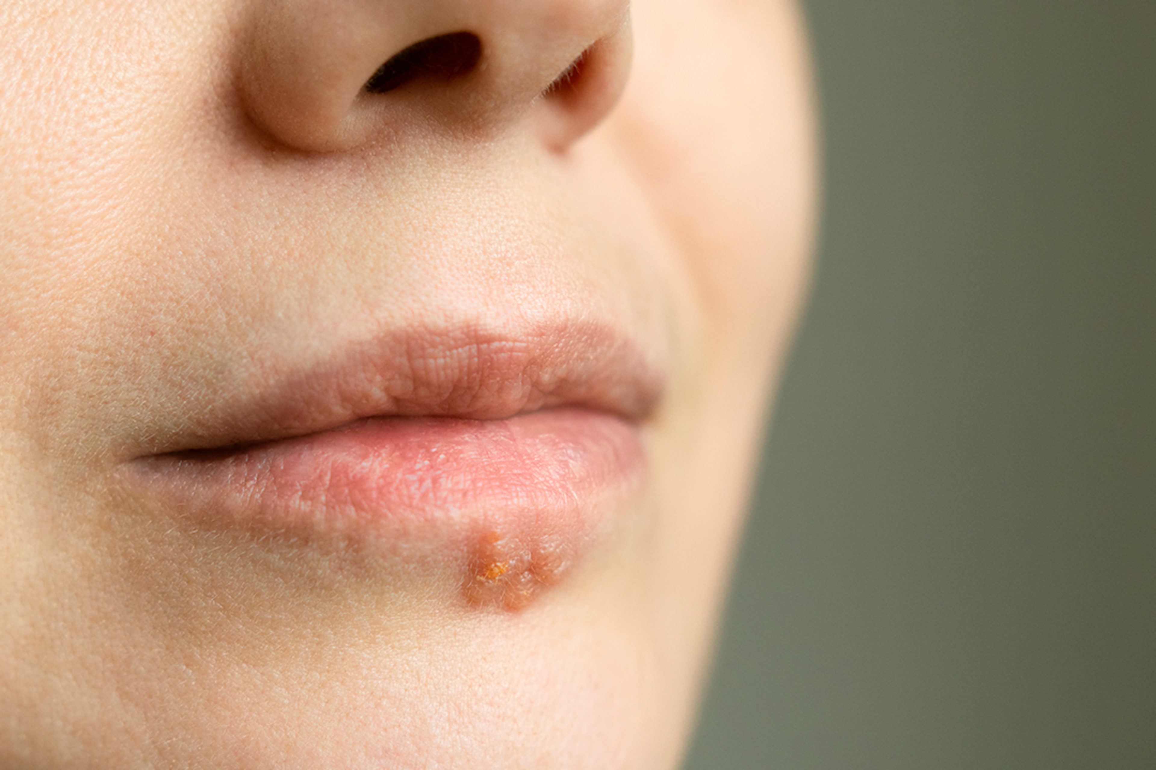 2025-06-25-gesundheitstipp-lippenherpes-bild-1080x1080_s